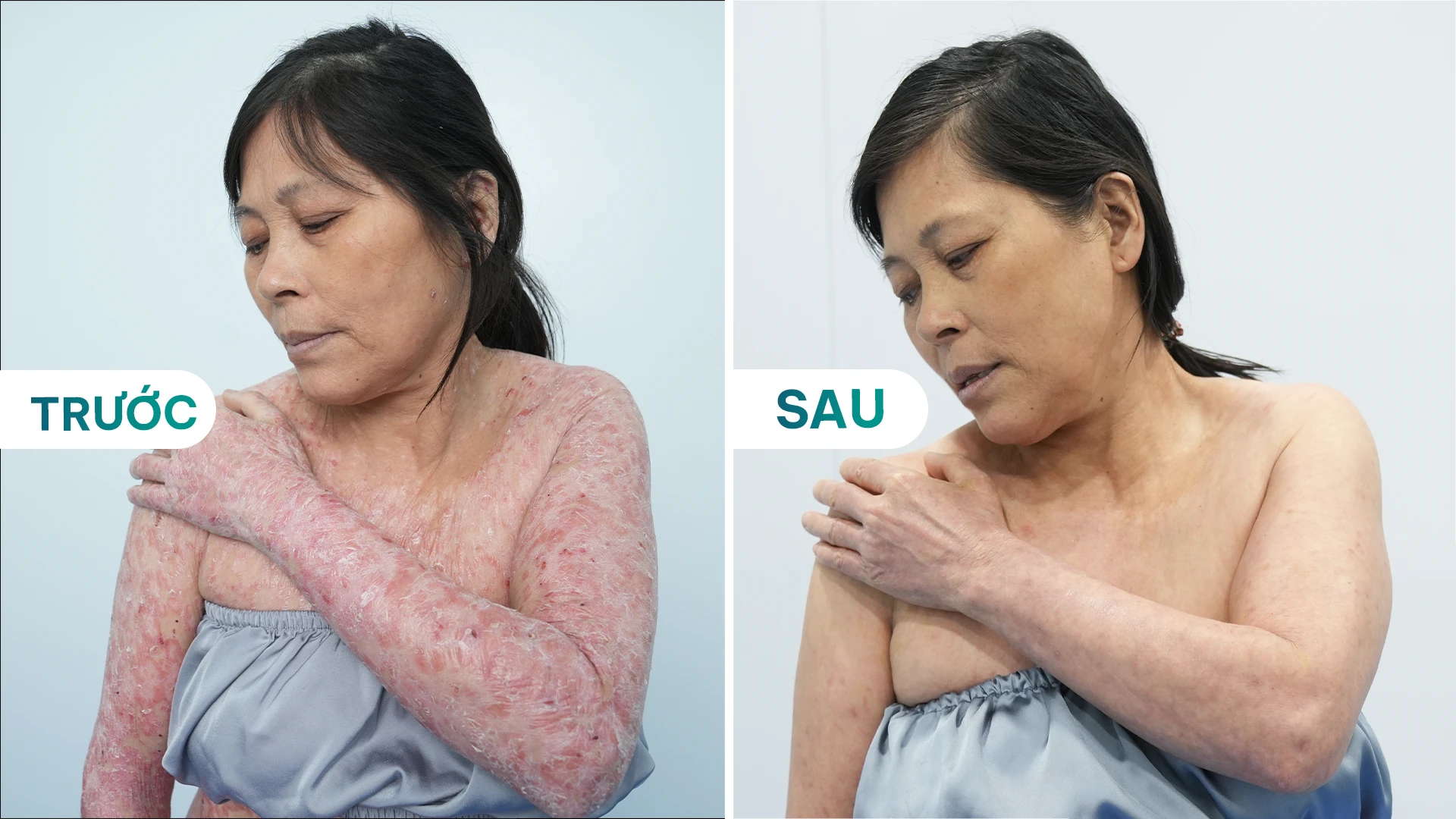 HÀNH TRÌNH ĐIỀU TRỊ VẨY NẾN CỦA BỆNH NH N LÊ THỊ HỢP: TỪ SỰ KHỔ ĐAU ĐẾN HY VỌNG MỚI